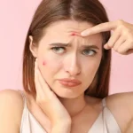 Overcoming Challenges With Spider Veins