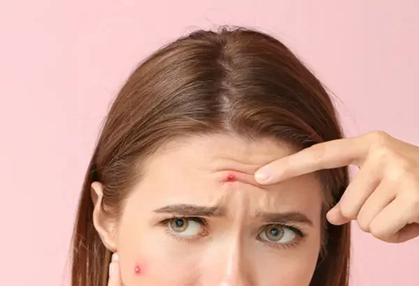 Overcoming Challenges With Spider Veins